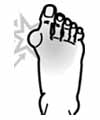 Illustration d'un pied souffrant d'hallux valgus, dans lequel le gros orteil est de travers et signale une douleur.