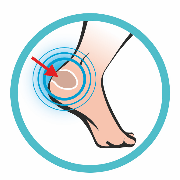 Illustration eines Fußes, bei dem ein roter Pfeil auf die Ferse zeigt, umgeben von blauen Kreisen. Foot Protector.